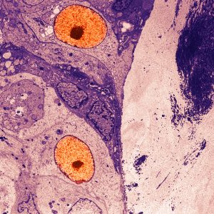 Study Supports that Breast Cancers Can Mount Immune Response