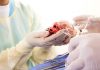 Transplant Score Could Improve Equitable Access to Donor Hearts