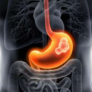 FDA Approves First Immunotherapy for Initial Treatment of Gastric Cancer