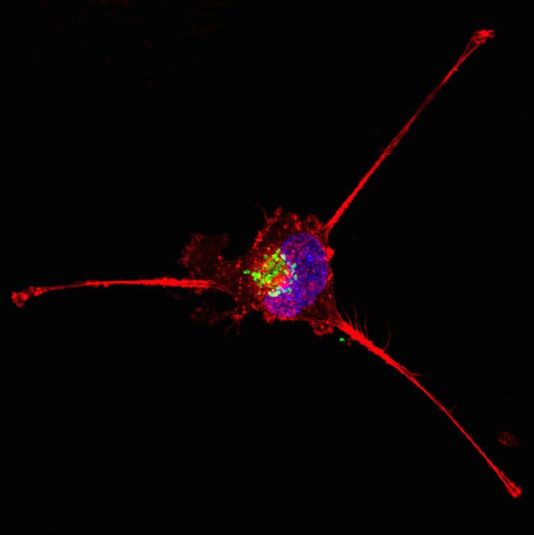 Triple negative breast cancer cell undergoing retraction and apoptosis