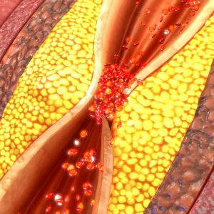 New Atherosclerotic Plaque Subtypes Unveiled