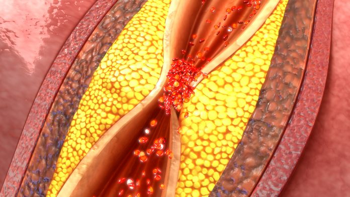 Coronary artery disease (CAD), atherosclerosis