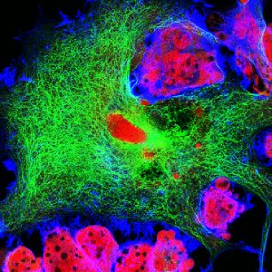 Gene Amplified in Neuroblastoma Promotes Tumor Growth via Lipid Metabolism