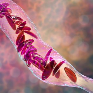 Mitochondrial DNA Triggers Inflammation in Sickle Cell Anemia Patients