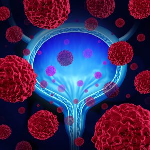 Chemo/Immunotherapy Response in Bladder Cancer Improved by Removing the Brake