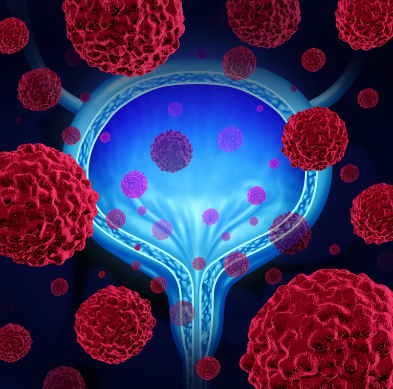 Genes Linked to Immunotherapy Resistance in Bladder Cancer Uncovered