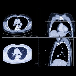 Program Using Incidental Lung Nodule Discovery Proves Effective at Early Cancer Detection