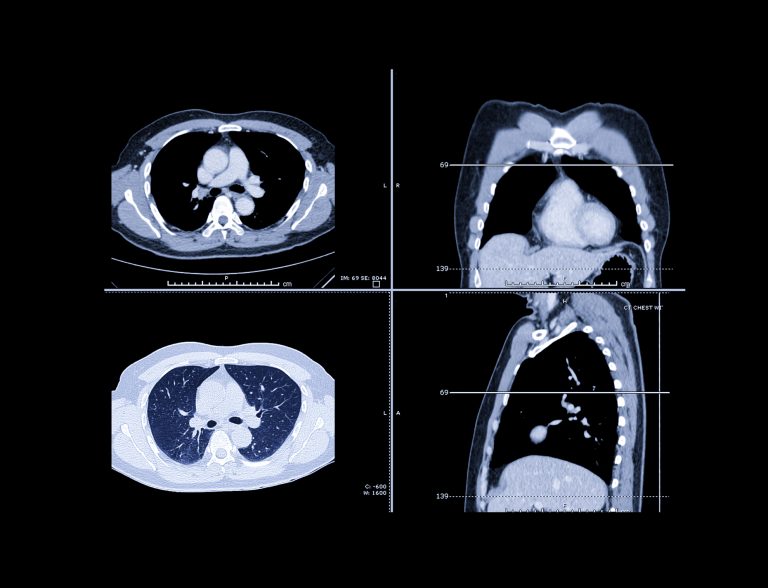 Comparison of CT Chest with contrast media Axial ,coronal and sagittal view for screen lung nodules and lung cancer .