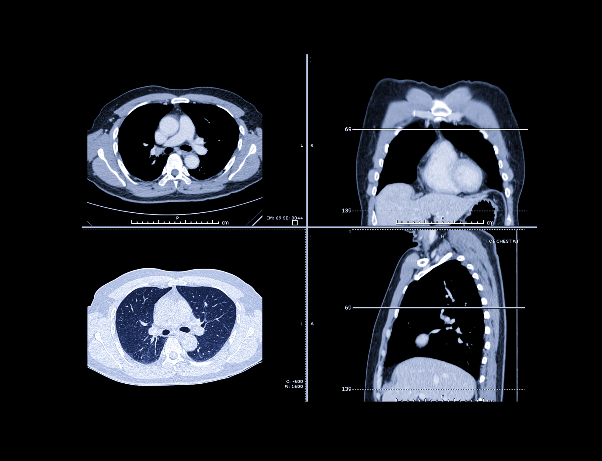 Etableret teori ubehageligt Produktion Program Using Incidental Lung Nodule Discovery Proves Effective at Early  Cancer Detection | Inside Precision Medicine