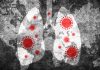 Combining AI with CT scans Can Help Detect Post-COVID Lung Damage