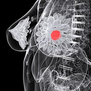 Antioxidant Could Help Combat Drug Resistance in Breast Cancer
