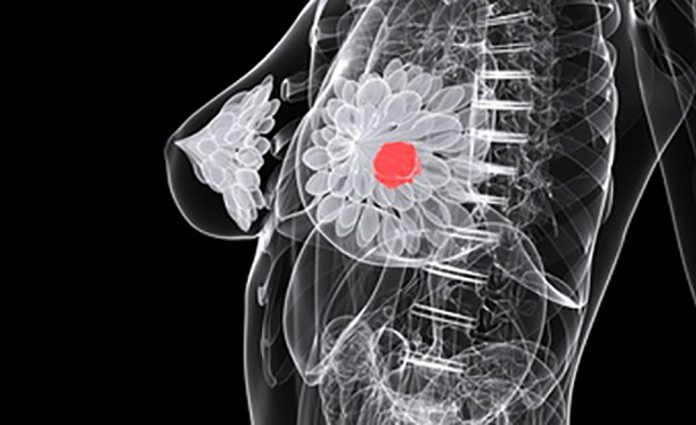 Outline X-ray type illustration of a woman with breast cancer. The diagnosis of which can be improved using AI analysis.