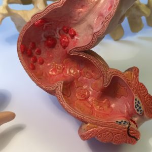 Novel IBD Treatment Strategy Seeks to Sequester Inflammation-Inducing Metabolite