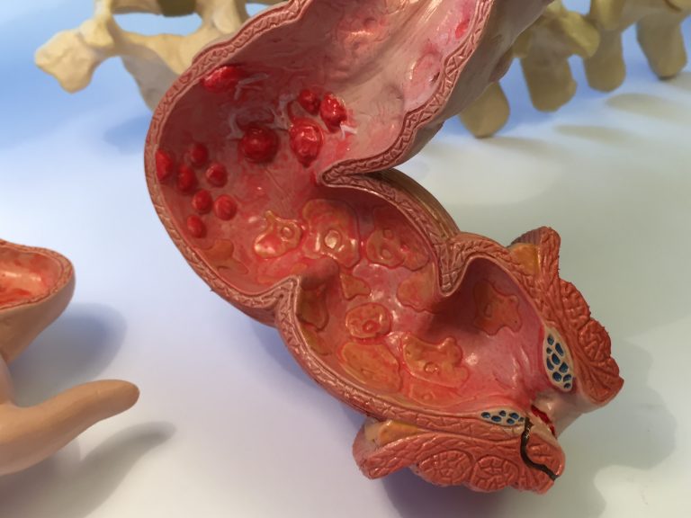 Anatomical model of human colon with signs of chronic bowel infection