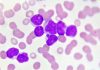 Patients Aged 80 to 90 Respond to Standard-of-Care AML Treatment