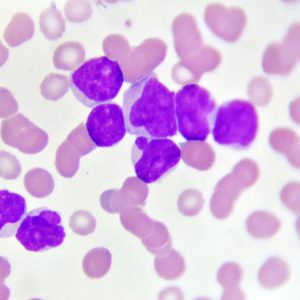 UVA Team Targets MLL Gene Fusion in Acute Myeloid Leukemia