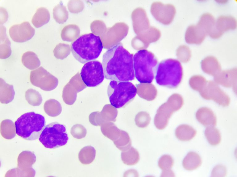 Acute Myeloid Leukemia Cells Rely on Little Known Protein for Survival