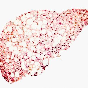 New Genes Linked to Nonalcoholic Fatty Liver Disease in Children