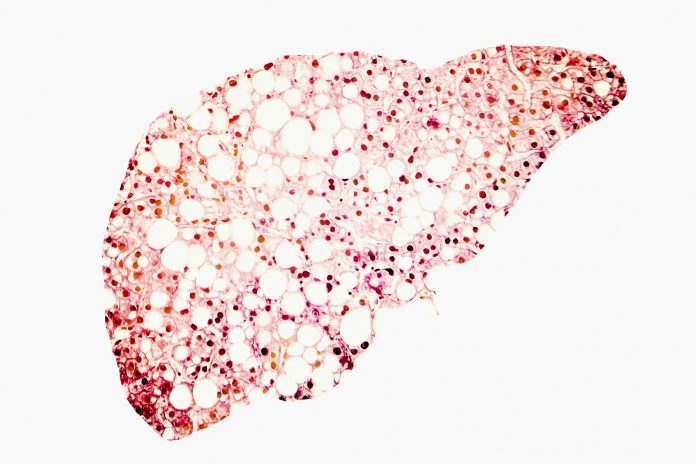 A conceptual illustration of Fatty liver cells in the shape of a liver