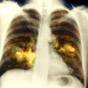 Lilly, NeoGenomics Partner on Non-Small Cell Lung Cancer Molecular Testing Program