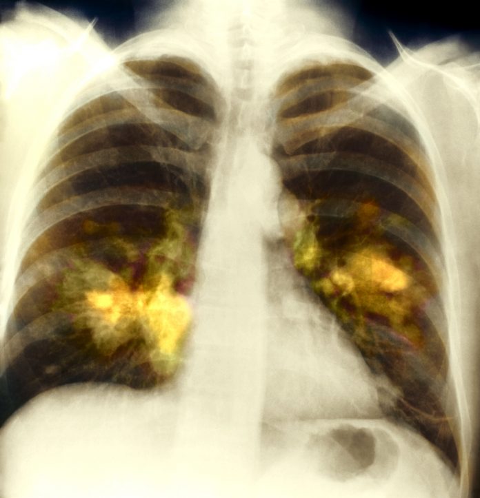 Lung cancer, close-up