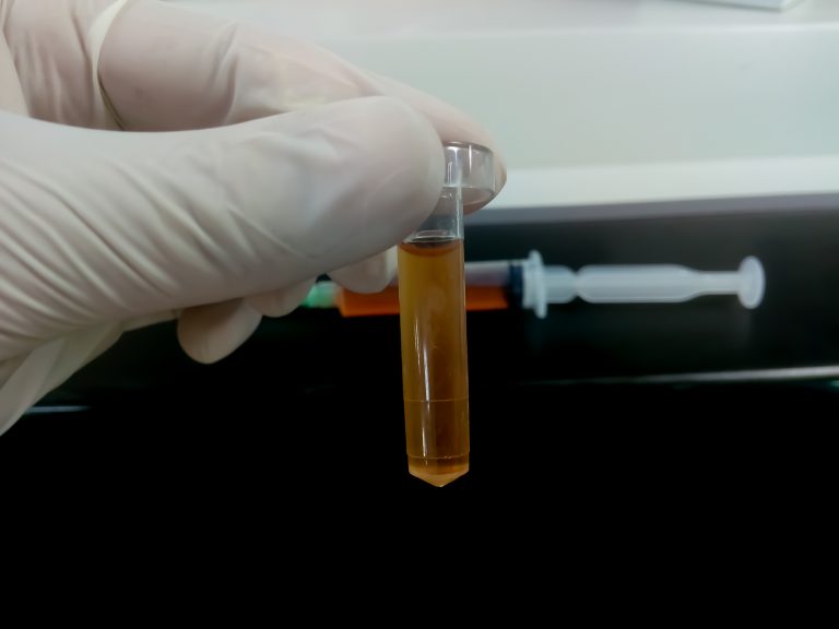 Medulloblastoma MRD Test Developed Using cfDNA from Cerebrospinal Fluid