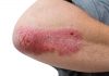 Gene Mutation That Causes Psoriasis Discovered