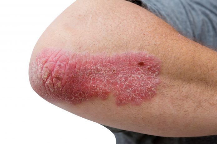 psoriasis on a mid age mans  elbow
