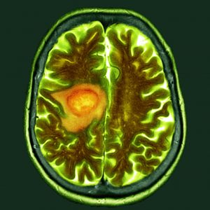 Circadian Clock Proteins Point to Potential Drug for Glioblastoma