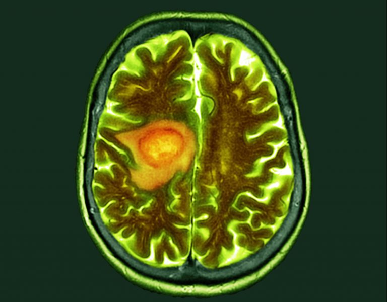 FAP-Targeting Imaging Tracker Prepares for Phase 1 Brain Cancer Trial