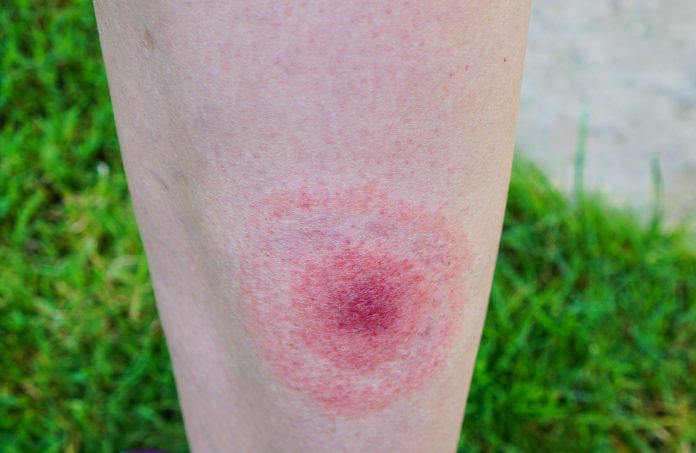 Picture of the leg of someone with a typical circular Lyme disease rash after being bitten by a deer tick