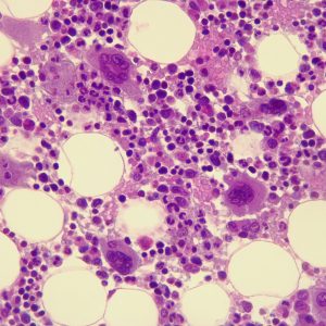 Momelotinib Performs Well at Phase III in Rare Bone Marrow Cancer Patients