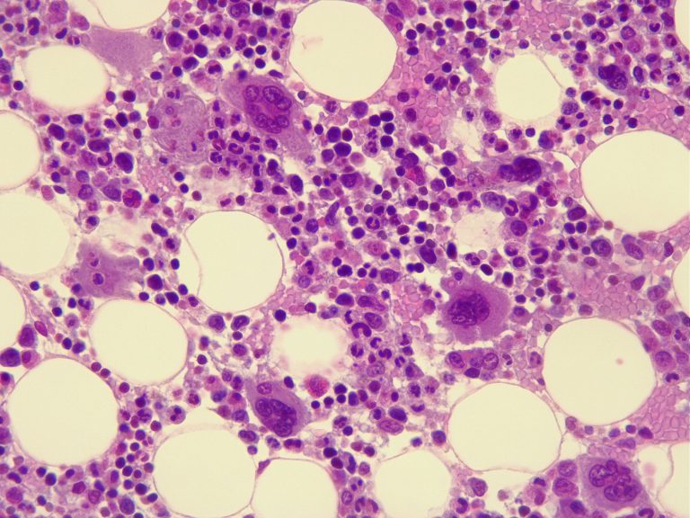 Human bone marrow under the microscope to illustrate myelofibrosis blood cancer