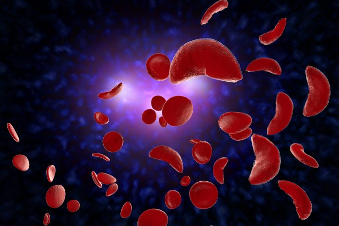 Sickle Cell disease - 3D Illustration of sickled blood cells on a dark background