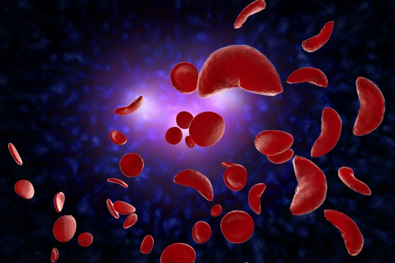 Base Editing Is Superior in Lab Test of Sickle Cell Disease Gene Therapy