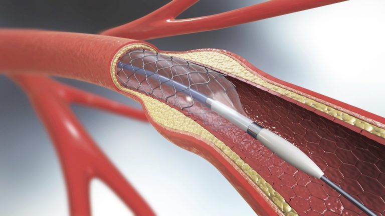 New Risk Score Predicts Contrast-Associated Kidney Injury in PCI