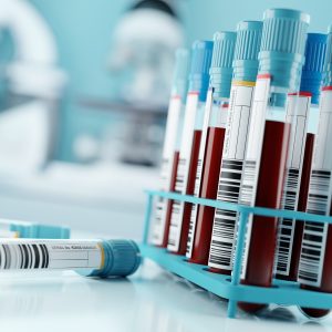 Blood-Test for HPV-Related Head and Neck Cancer Developed