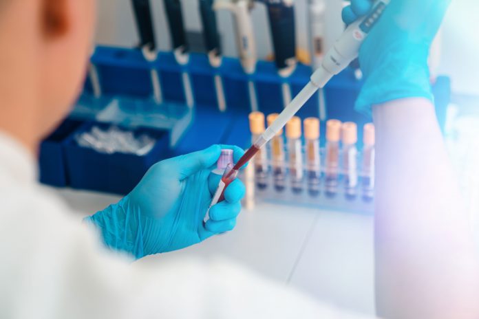 Close up of human biotechnologist testing testing blood for cancer in a laboratory