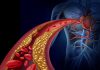 Cardiovascular Disease Onset Can Be Predicted Using AI Tools