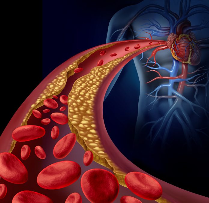 红细胞在堵塞的动脉中移动的图示