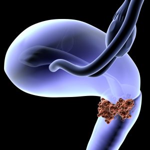 Anti-PD1/Anti-CTLA4 Combo Therapy Shows Promise Against Cervical Cancer