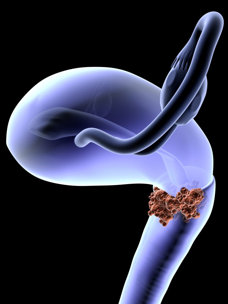 Digital representation of cervical cancer