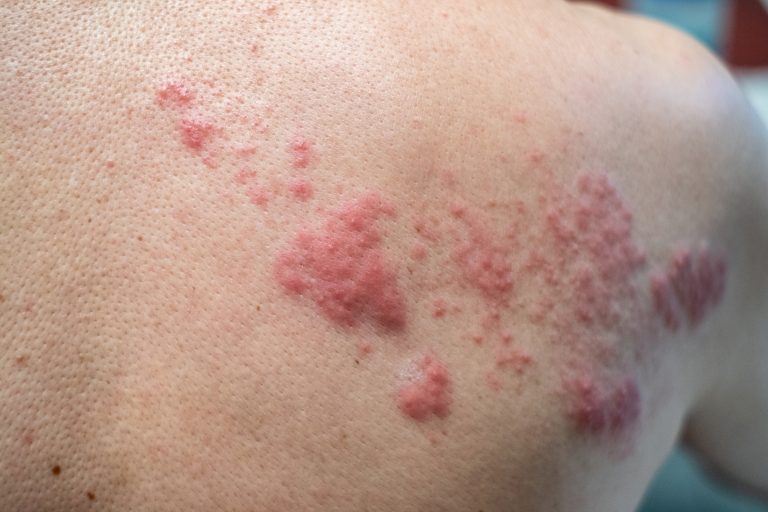Shingles (Disease), Herpes zoster, varicella-zoster virus. skin rash and blisters