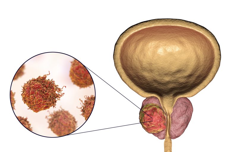 Illustration showing tumor inside prostate gland and closeup view of prostate cancer cells to the left of the image.
