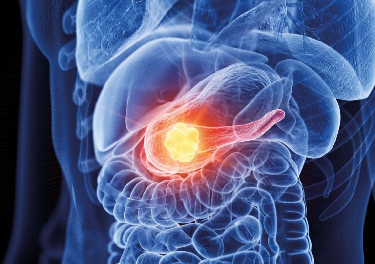 Pancreatic Cancer Trial Launched by TGen, HonorHealth, and SBI