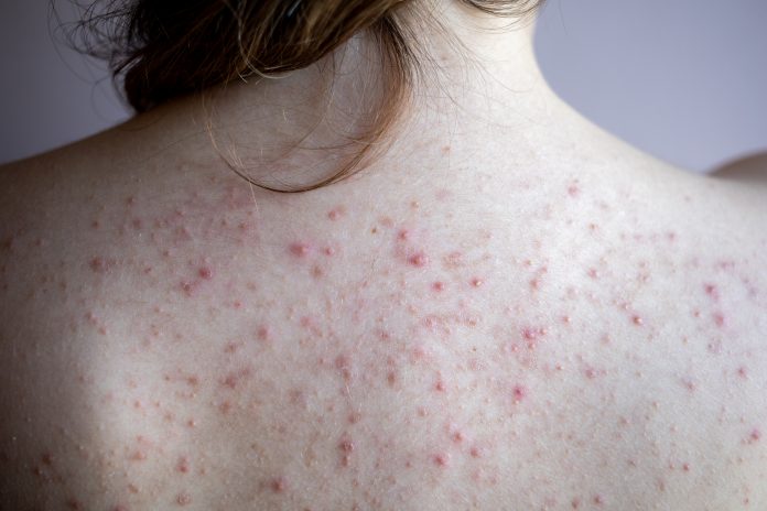 woman back with acne, red spots, skin disease