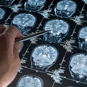 A Matter of Timing: Rudy Tanzi on Alzheimer’s Disease