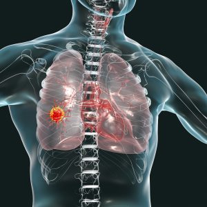 Gatekeeper Gene Linked with Aggressive Lung Cancers