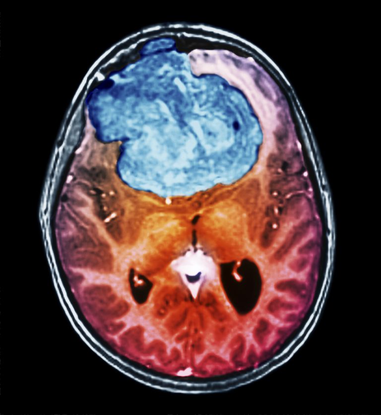 Benign brain tumour, CT scan