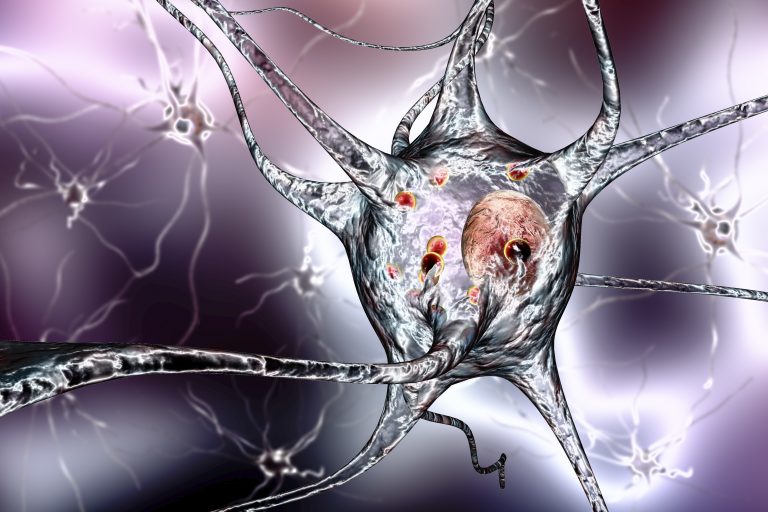 Parkinsons disease nerve cells, illustration